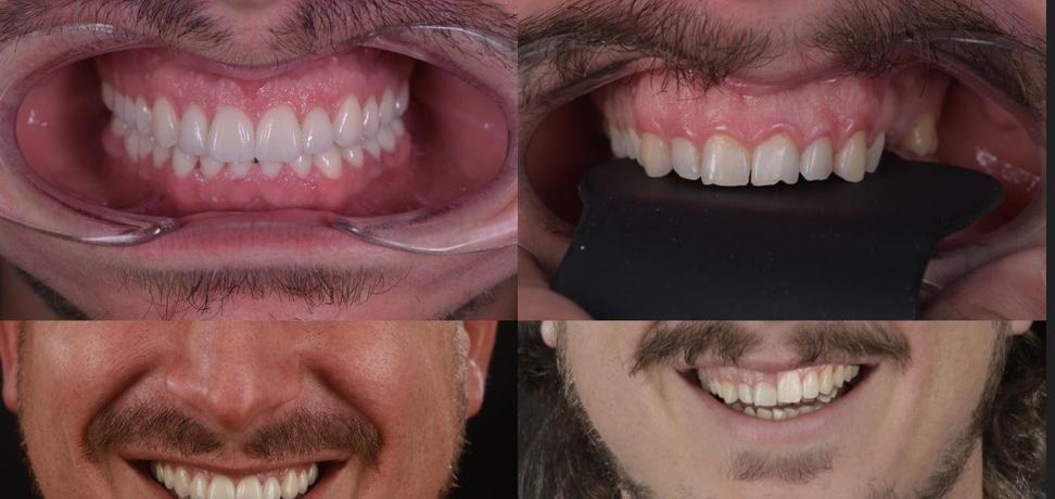 VisionSmile